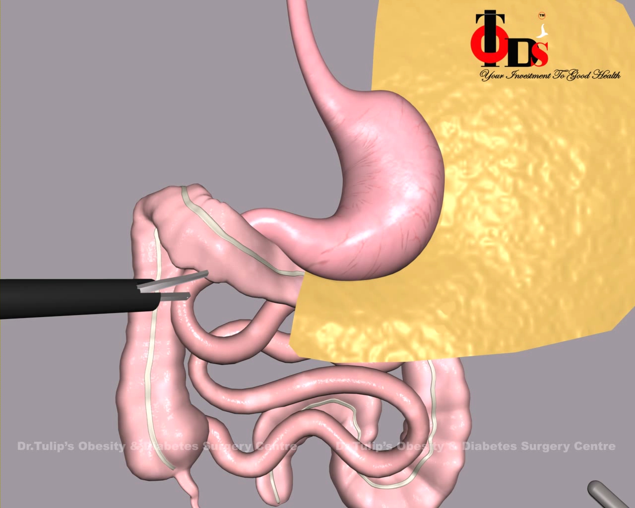  Sleeve Gastrectomy im1